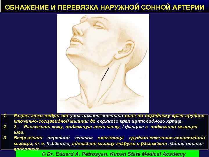ОБНАЖЕНИЕ И ПЕРЕВЯЗКА НАРУЖНОЙ СОННОЙ АРТЕРИИ 1. 2. 3. Разрез кожи ведут от угла