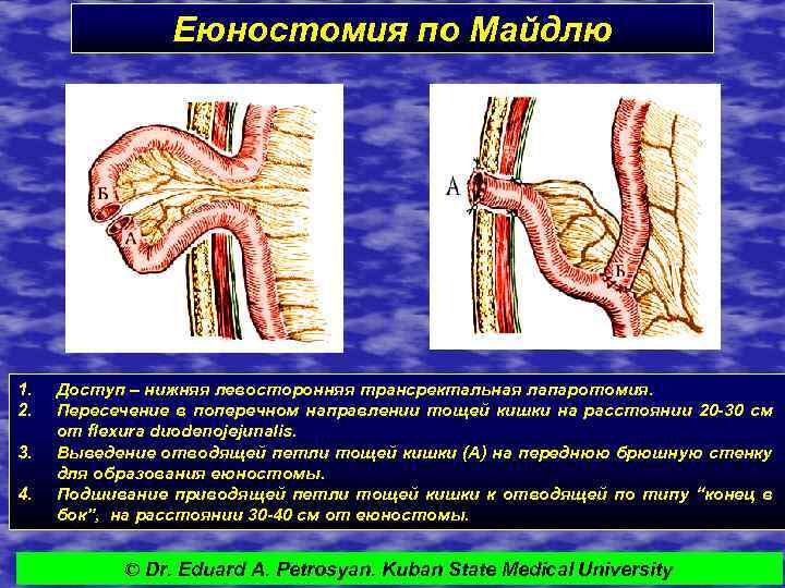 Еюностомия по Майдлю 1. 2. 3. 4. Доступ – нижняя левосторонняя трансректальная лапаротомия. Пересечение