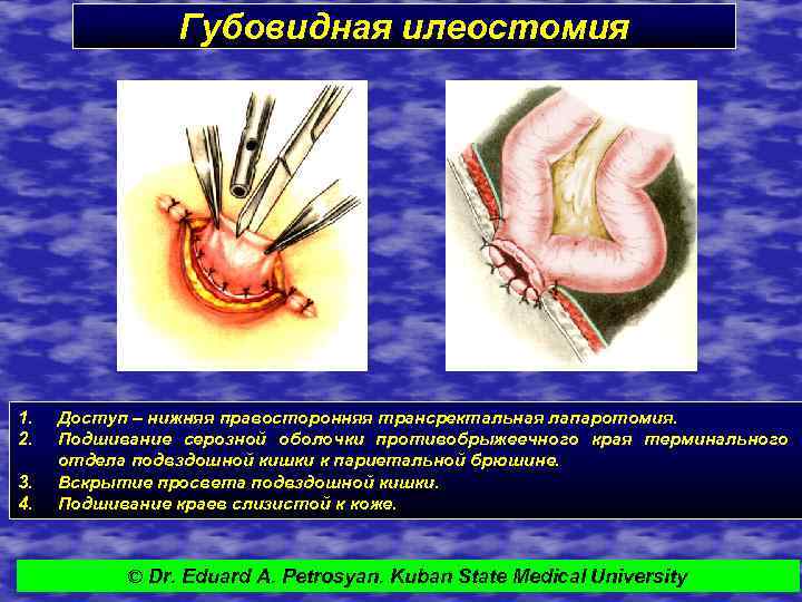Губовидная илеостомия 1. 2. 3. 4. Доступ – нижняя правосторонняя трансректальная лапаротомия. Подшивание серозной