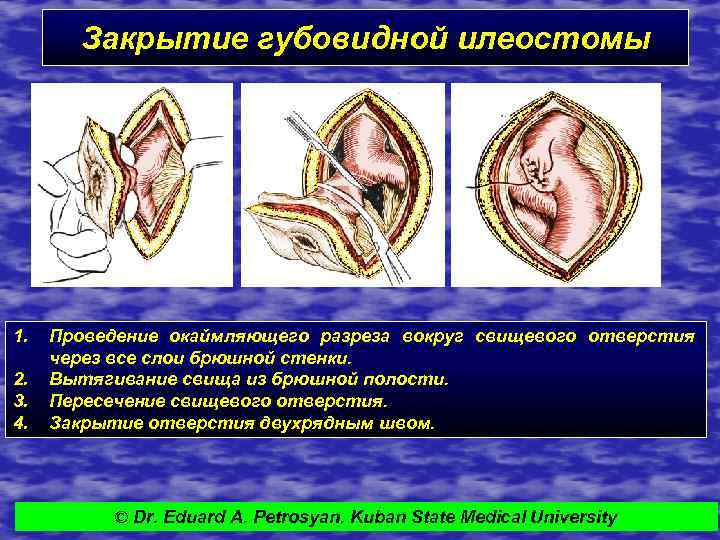 Закрытие губовидной илеостомы 1. 2. 3. 4. Проведение окаймляющего разреза вокруг свищевого отверстия через