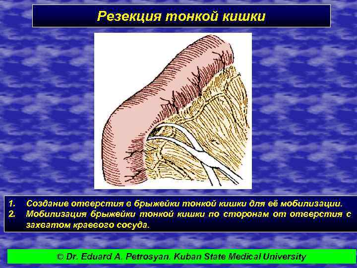 Корень брыжейки тонкой кишки