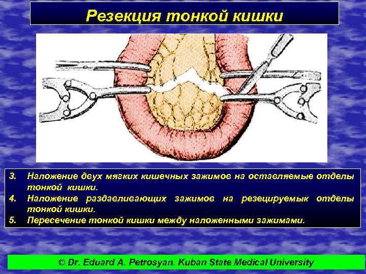 Резекция тонкой кишки 3. 4. 5. Наложение двух мягких кишечных зажимов на оставляемые отделы