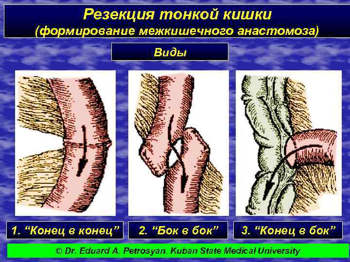 Резекция тонкой кишки (формирование межкишечного анастомоза) Виды 1. “Конец в конец” 2. “Бок в
