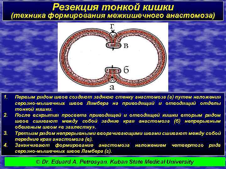 Резекция тонкой кишки (техника формирования межкишечного анастомоза) 1. 2. 3. 4. Первым рядом швов