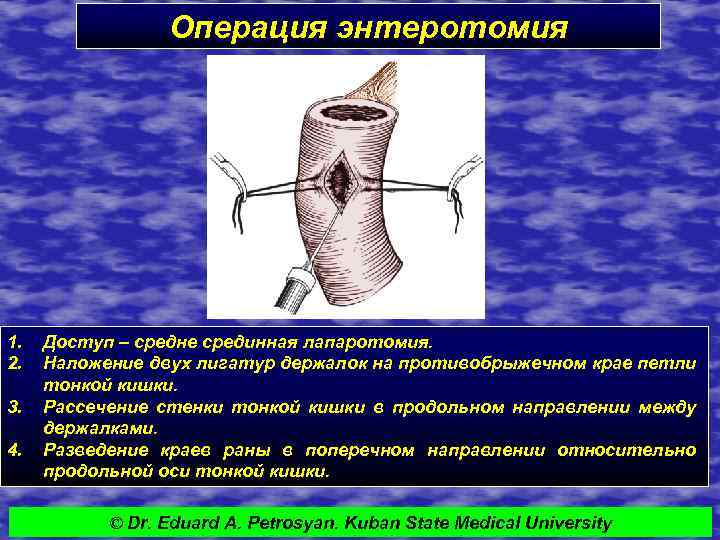 Операция энтеротомия 1. 2. 3. 4. Доступ – средне срединная лапаротомия. Наложение двух лигатур