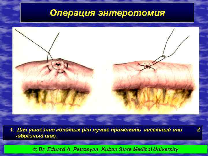 Операция энтеротомия 1. Для ушивания колотых ран лучше применять кисетный или -образный шов. ©