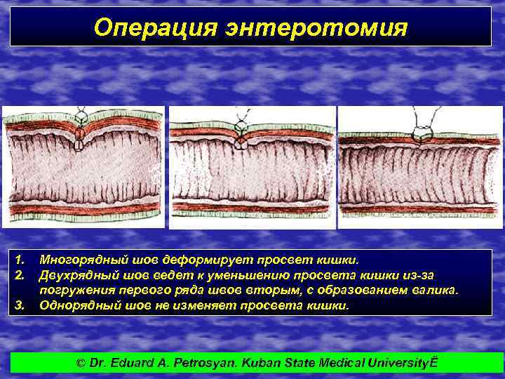 Операция энтеротомия 1. 2. 3. Многорядный шов деформирует просвет кишки. Двухрядный шов ведет к