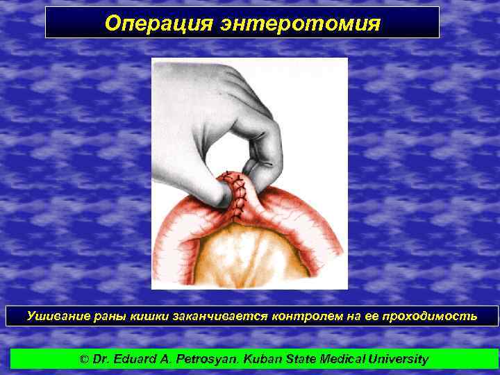 Операция энтеротомия Ушивание раны кишки заканчивается контролем на ее проходимость © Dr. Eduard A.