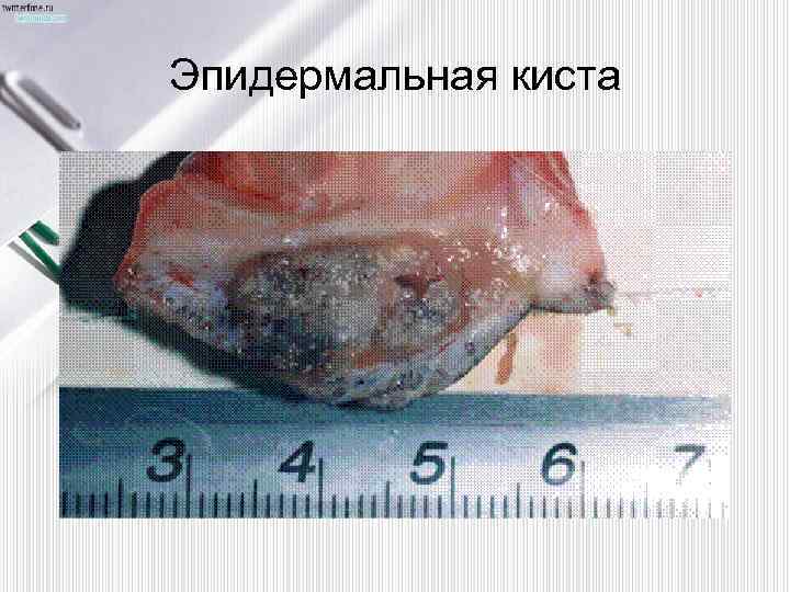 Эпидермальная киста 