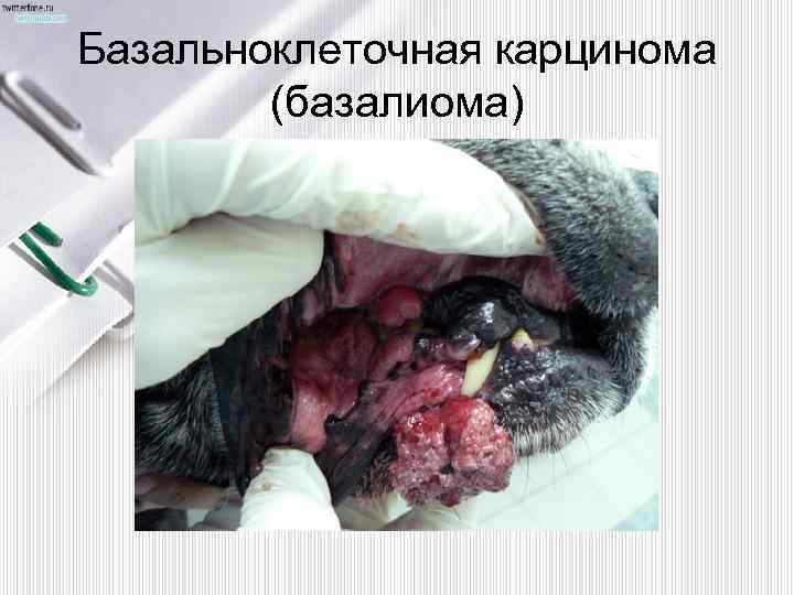 Базальноклеточная карцинома (базалиома) 