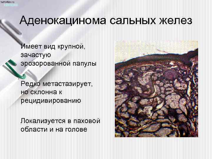 Аденокацинома сальных желез Имеет вид крупной, зачастую эрозорованной папулы Редко метастазирует, но склонна к