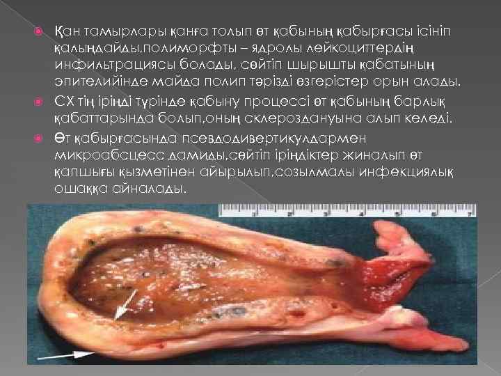 Қан тамырлары қанға толып өт қабының қабырғасы ісініп қалыңдайды, полиморфты – ядролы лейкоциттердің инфильтрациясы