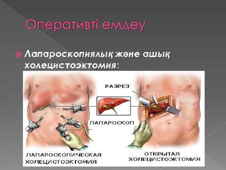 Оперативті емдеу Лапароскопиялық және ашық холецистоэктомия: 