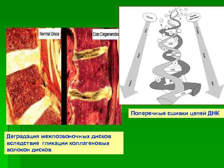 Поперечные сшивки цепей ДНК Деградация межпозвоночных дисков вследствие гликации коллагеновых волокон дисков 