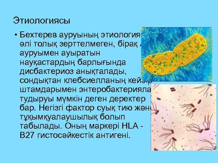 Этиологиясы • Бехтерев ауруының этиологиясы әлі толық зерттелмеген, бірақ АС ауруымен ауыратын науқастардың барлығында