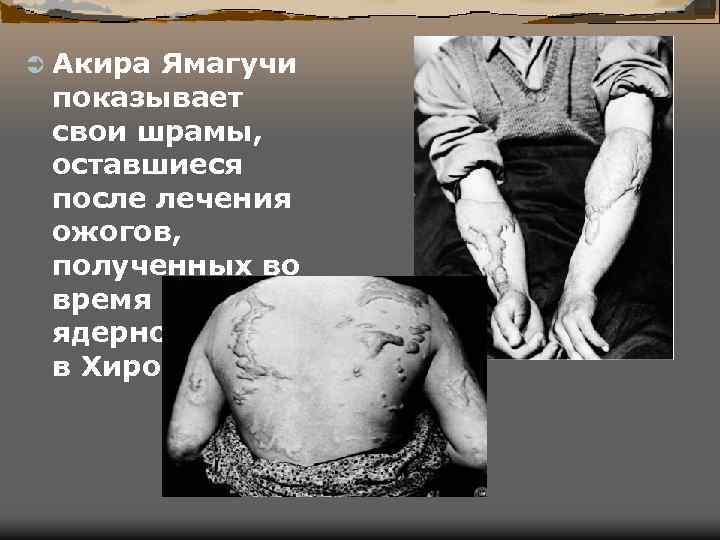 Ü Акира Ямагучи показывает свои шрамы, оставшиеся после лечения ожогов, полученных во время взрыва