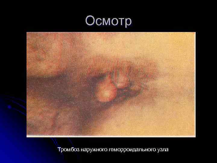 Осмотр Тромбоз наружного геморроидального узла 