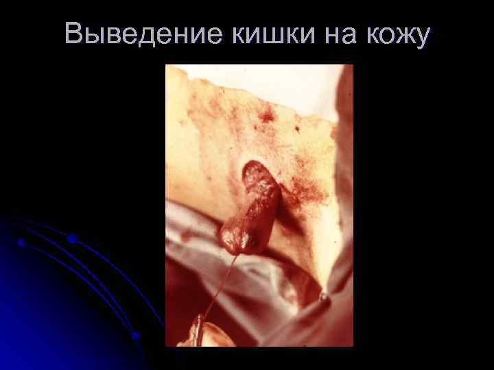 Выведение кишки на кожу 