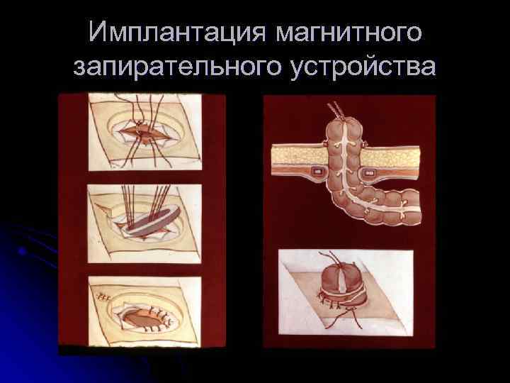 Имплантация магнитного запирательного устройства 
