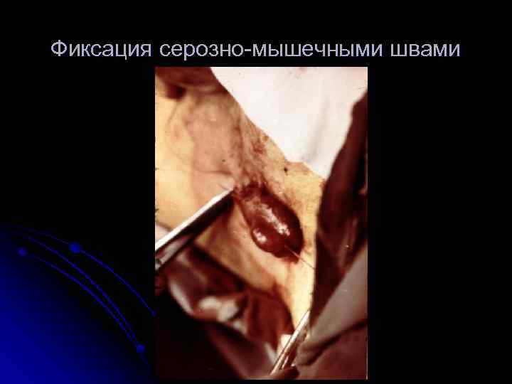 Фиксация серозно мышечными швами 