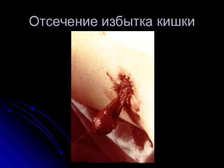 Отсечение избытка кишки 