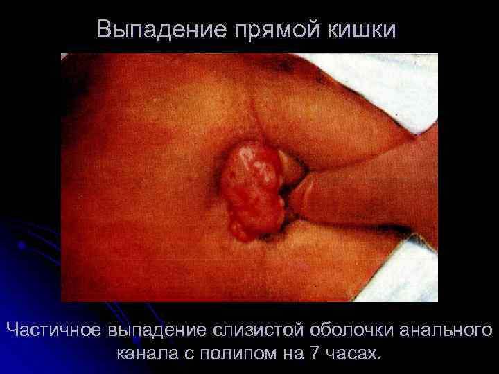 Выпадение прямой кишки Частичное выпадение слизистой оболочки анального канала с полипом на 7 часах.
