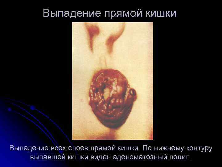 Выпадение прямой кишки Выпадение всех слоев прямой кишки. По нижнему контуру выпавшей кишки виден