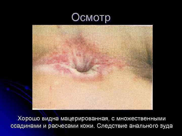Осмотр Хорошо видна мацерированная, с множественными ссадинами и расчесами кожи. Следствие анального зуда 