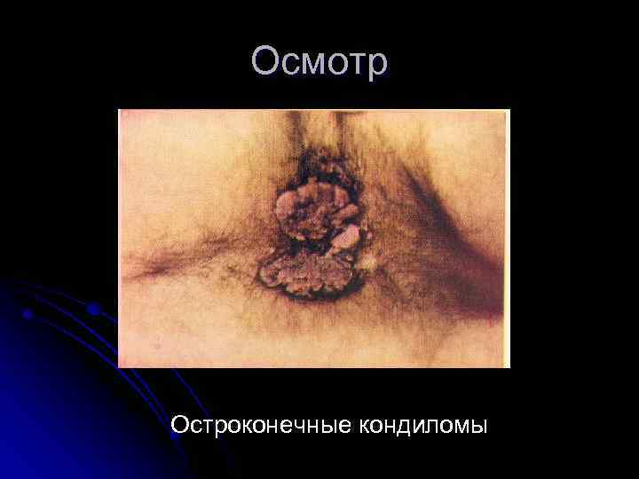Осмотр Остроконечные кондиломы 