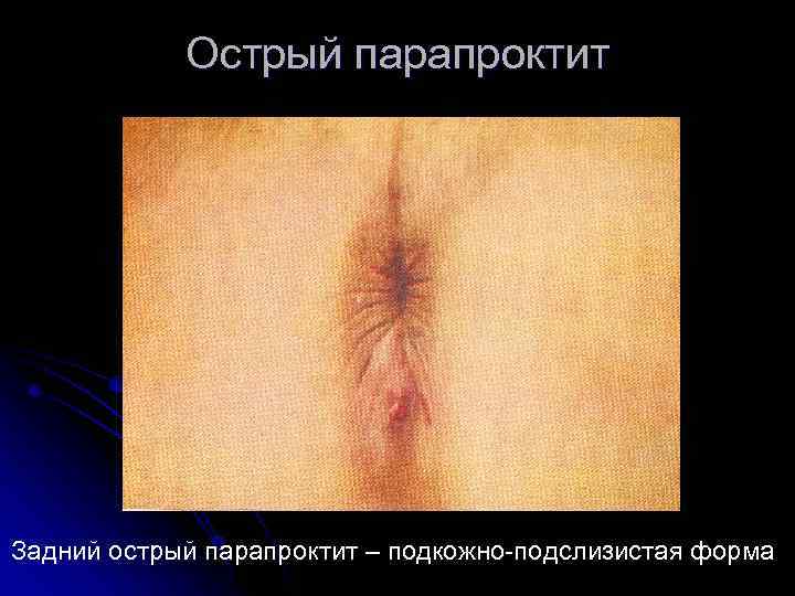 Острый парапроктит Задний острый парапроктит – подкожно подслизистая форма 