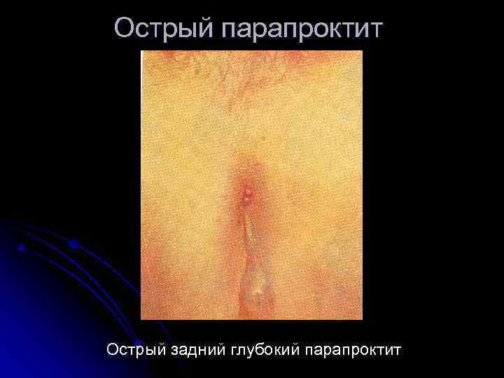 Острый парапроктит Острый задний глубокий парапроктит 