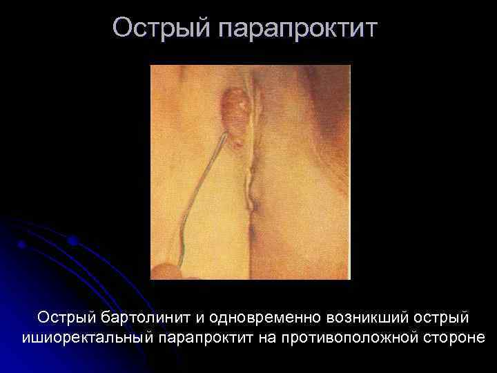 Острый парапроктит Острый бартолинит и одновременно возникший острый ишиоректальный парапроктит на противоположной стороне 