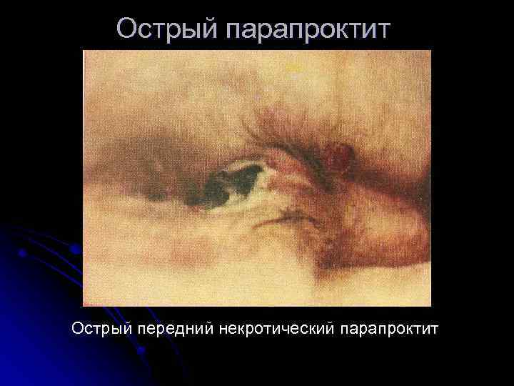 Острый парапроктит Острый передний некротический парапроктит 