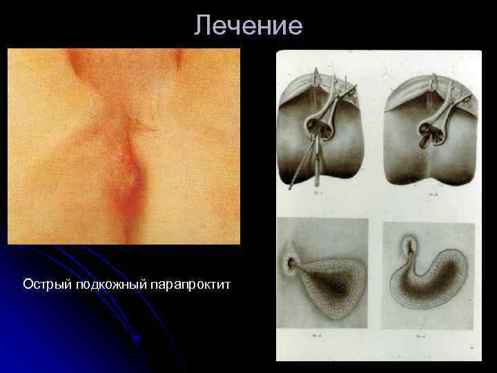 Лечение Острый подкожный парапроктит 