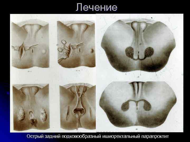 Лечение Острый задний подковообразный ишиоректальный парапроктит 