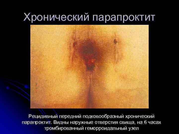 Хронический парапроктит Рецидивный передний подковообразный хронический парапроктит. Видны наружные отверстия свища, на 6 часах