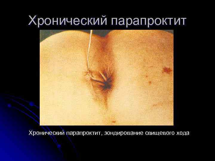 Хронический парапроктит, зондирование свищевого хода 