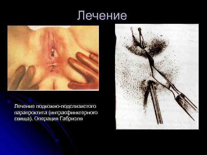 Лечение подкожно подслизистого парапроктита (интрасфинктерного свища). Операция Габриэля 