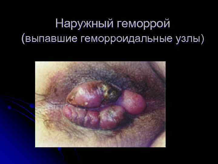 Наружный геморрой (выпавшие геморроидальные узлы) 