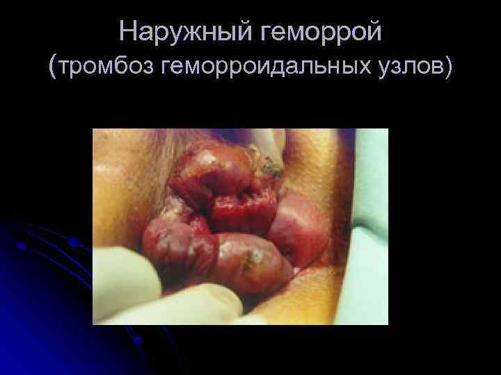 Наружный геморрой (тромбоз геморроидальных узлов) 