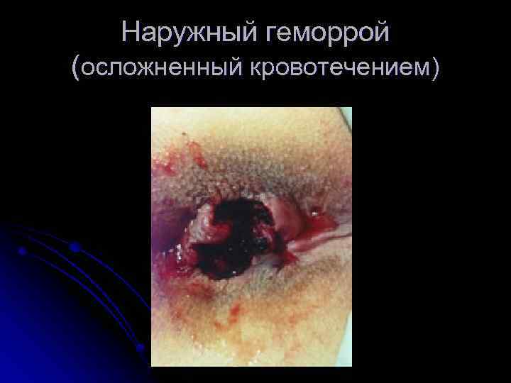 Наружный геморрой (осложненный кровотечением) 