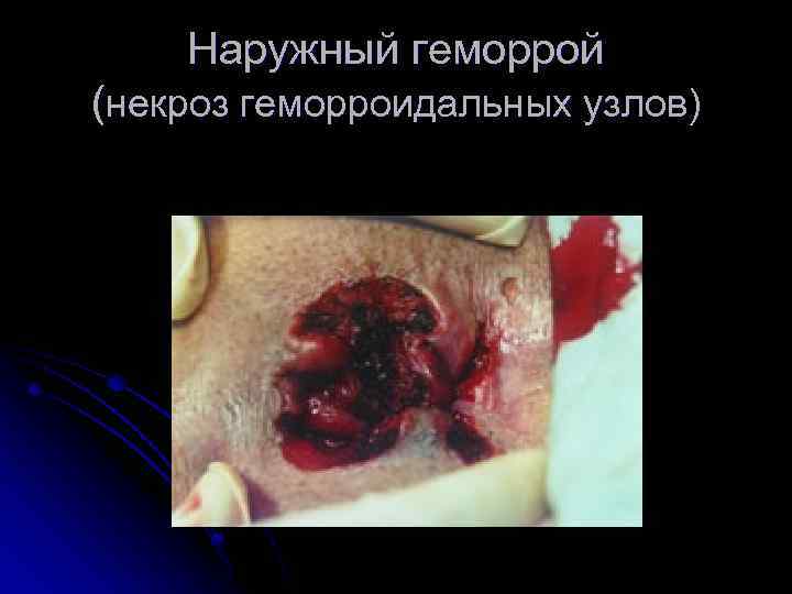 Наружный геморрой (некроз геморроидальных узлов) 