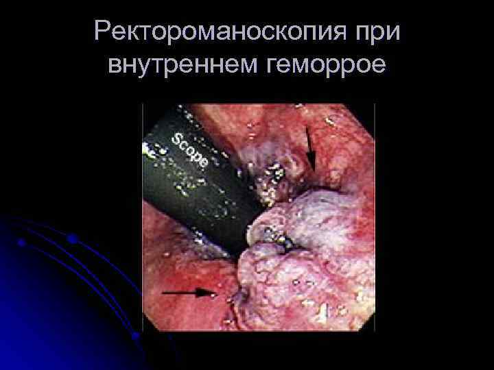 Ректороманоскопия при внутреннем геморрое 