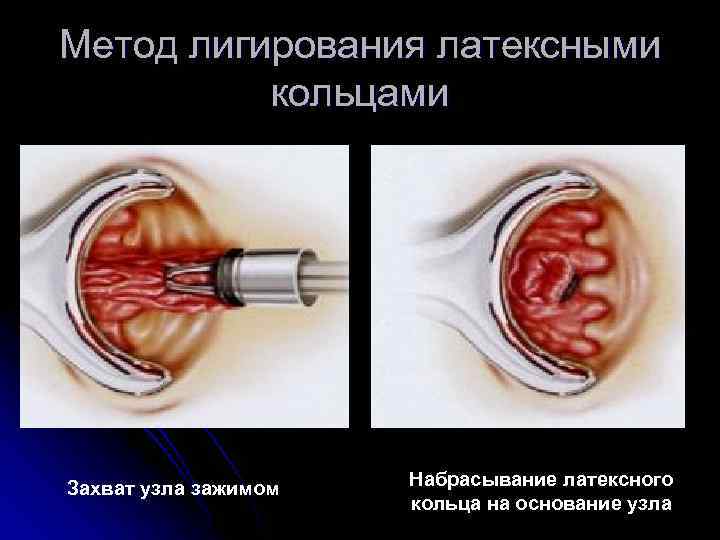 Метод лигирования латексными кольцами Захват узла зажимом Набрасывание латексного кольца на основание узла 