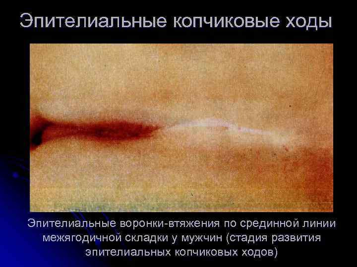 Эпителиальные копчиковые ходы Эпителиальные воронки втяжения по срединной линии межягодичной складки у мужчин (стадия