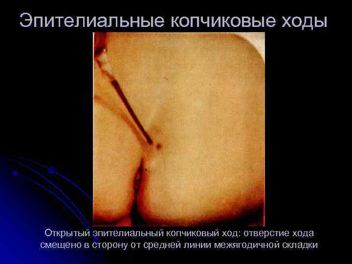 Эпителиальные копчиковые ходы Открытый эпителиальный копчиковый ход: отверстие хода смещено в сторону от средней