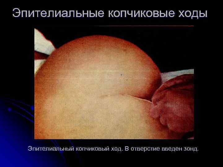 Эпителиальные копчиковые ходы Эпителиальный копчиковый ход. В отверстие введен зонд. 
