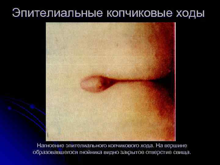 Эпителиальные копчиковые ходы Нагноение эпителиального копчикового хода. На вершине образовавшегося гнойника видно закрытое отверстие