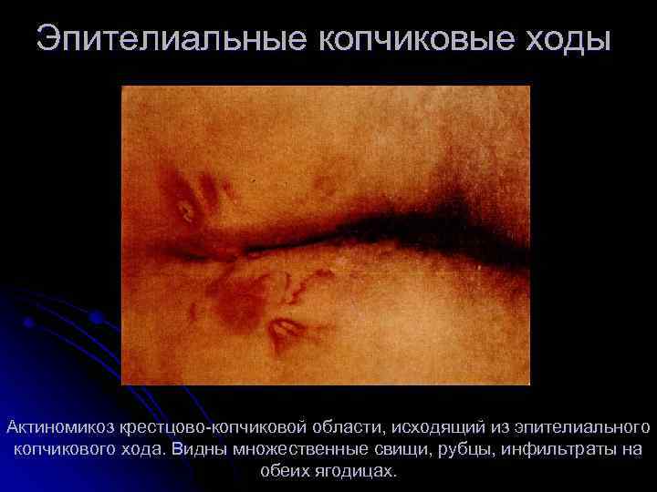 Эпителиальные копчиковые ходы Актиномикоз крестцово копчиковой области, исходящий из эпителиального копчикового хода. Видны множественные