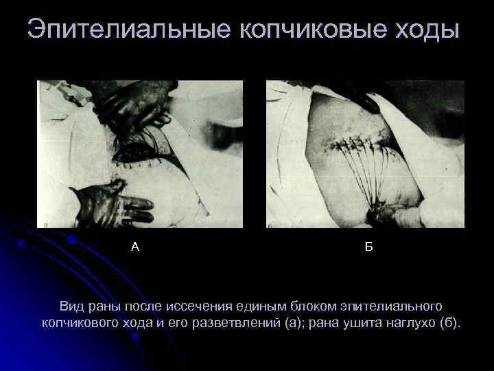 Эпителиальные копчиковые ходы А Б Вид раны после иссечения единым блоком эпителиального копчикового хода